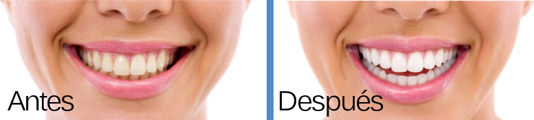 blanqueamiento dental - Antes y después